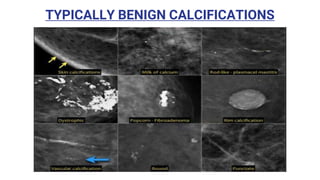 TYPICALLY BENIGN CALCIFICATIONS
 