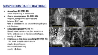 SUSPICIOUS CALCIFICATIONS
● Amorphous (BI-RADS 4B)
Small and/or hazy in appearance
● Coarse heterogeneous (BI-RADS 4B)
Irregular, conspicuous calcifications
between 0.5-1 mm
tend to coalesce but are smaller than dystrophic
calcifications.
● Fine pleomorphic (BI-RADS 4C)
Usually more conspicuous than amorphous
forms and are seen to have discrete shapes,
usually < 0.5 mm
● Fine linear or fine-linear branching (BI-RADS 4C)
Thin, linear irregular calcifications
may be discontinuous
occasionally branching
usually < 0.5 mm
 