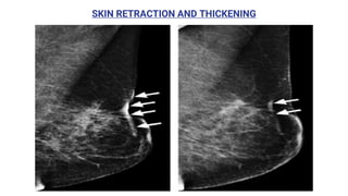 SKIN RETRACTION AND THICKENING
 