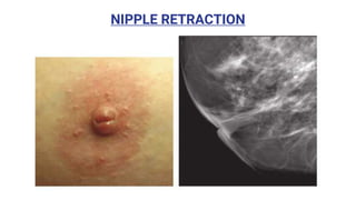 NIPPLE RETRACTION
 