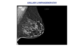 AXILLARY LYMPHADENOPATHY
 