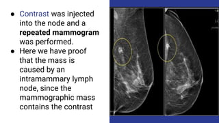● Contrast was injected
into the node and a
repeated mammogram
was performed.
● Here we have proof
that the mass is
caused by an
intramammary lymph
node, since the
mammographic mass
contains the contrast
 