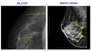 OIL CYST BREAST LIPOMA
 