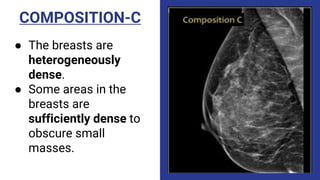 COMPOSITION-C
● The breasts are
heterogeneously
dense.
● Some areas in the
breasts are
sufficiently dense to
obscure small
masses.
 