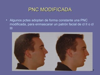 107
PNC MODIFICADAPNC MODIFICADA
• Algunos pctes adoptan de forma constante una PNC
modificada, para enmascarar un patrón facial de cl II o cl
III
 