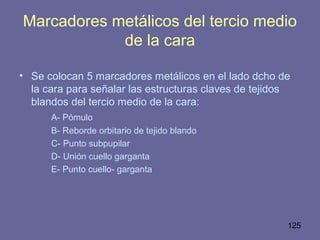 125
Marcadores metálicos del tercio medio
de la cara
• Se colocan 5 marcadores metálicos en el lado dcho de
la cara para señalar las estructuras claves de tejidos
blandos del tercio medio de la cara:
A- Pómulo
B- Reborde orbitario de tejido blando
C- Punto subpupilar
D- Unión cuello garganta
E- Punto cuello- garganta
 