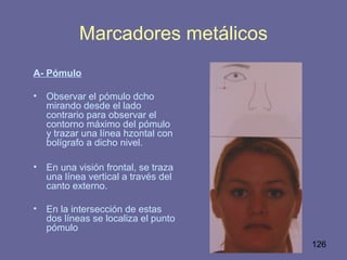 126
Marcadores metálicos
A- Pómulo
• Observar el pómulo dcho
mirando desde el lado
contrario para observar el
contorno máximo del pómulo
y trazar una línea hzontal con
bolígrafo a dicho nivel.
• En una visión frontal, se traza
una línea vertical a través del
canto externo.
• En la intersección de estas
dos líneas se localiza el punto
pómulo
 