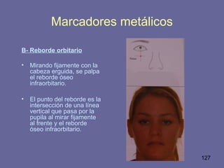 127
B- Reborde orbitario
• Mirando fijamente con la
cabeza erguida, se palpa
el reborde óseo
infraorbitario.
• El punto del reborde es la
intersección de una línea
vertical que pasa por la
pupila al mirar fijamente
al frente y el reborde
óseo infraorbitario.
Marcadores metálicos
 