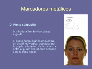 129
D- Punto subpupilar
la mirada al frente y la cabeza
erguida
el punto subpupilar se encuentra
en una línea vertical que pasa por
la pupila, a la mitad de la distancia
entre el punto del reborde orbitario
y de la base nasal.
Marcadores metálicos
 