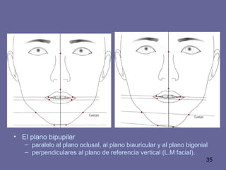 35
• El plano bipupilar
– paralelo al plano oclusal, al plano biauricular y al plano bigonial
– perpendiculares al plano de referencia vertical (L.M facial).
 