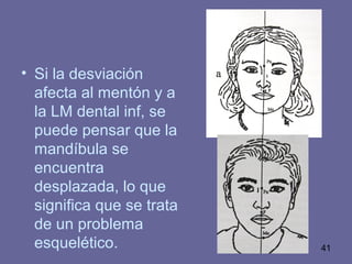 41
• Si la desviación
afecta al mentón y a
la LM dental inf, se
puede pensar que la
mandíbula se
encuentra
desplazada, lo que
significa que se trata
de un problema
esquelético.
 
