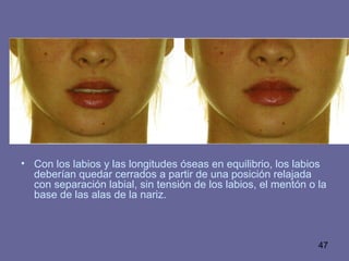 47
• Con los labios y las longitudes óseas en equilibrio, los labios
deberían quedar cerrados a partir de una posición relajada
con separación labial, sin tensión de los labios, el mentón o la
base de las alas de la nariz.
 