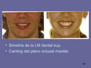 60
• Simetria de la LM dental sup.
• Canting del plano oclusal maxilar.
 