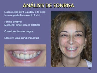 62
ANÁLISIS DE SONRISAANÁLISIS DE SONRISA
Línea media dent sup desv a la dcha
1mm respecto línea media facial
Sonrisa gingival
Márgenes gingivales no estéticos
Corredores bucales negros
Labio inf sigue curva incisal sup
 