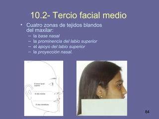 84
10.2- Tercio facial medio
• Cuatro zonas de tejidos blandos
del maxilar:
– la base nasal
– la prominencia del labio superior
– el apoyo del labio superior
– la proyección nasal.
 
