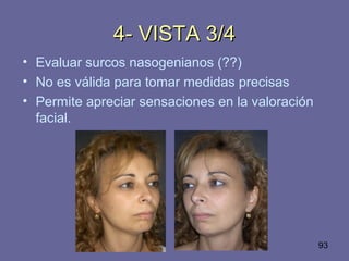 93
4- VISTA 3/44- VISTA 3/4
• Evaluar surcos nasogenianos (??)
• No es válida para tomar medidas precisas
• Permite apreciar sensaciones en la valoración
facial.
 