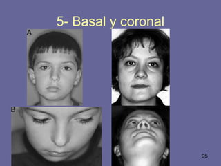 95
5- Basal y coronal
 