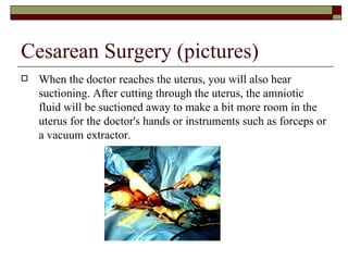 Cesarean Surgery (pictures)
   When the doctor reaches the uterus, you will also hear
    suctioning. After cutting through the uterus, the amniotic
    fluid will be suctioned away to make a bit more room in the
    uterus for the doctor's hands or instruments such as forceps or
    a vacuum extractor.
 