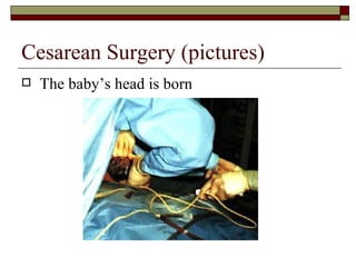 Cesarean Surgery (pictures)
   The baby’s head is born
 