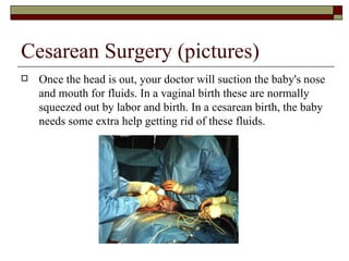 Cesarean Surgery (pictures)
   Once the head is out, your doctor will suction the baby's nose
    and mouth for fluids. In a vaginal birth these are normally
    squeezed out by labor and birth. In a cesarean birth, the baby
    needs some extra help getting rid of these fluids.
 