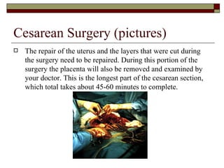Cesarean Surgery (pictures)
   The repair of the uterus and the layers that were cut during
    the surgery need to be repaired. During this portion of the
    surgery the placenta will also be removed and examined by
    your doctor. This is the longest part of the cesarean section,
    which total takes about 45-60 minutes to complete.
 