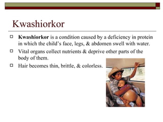 Kwashiorkor
   Kwashiorkor is a condition caused by a deficiency in protein
    in which the child’s face, legs, & abdomen swell with water.
   Vital organs collect nutrients & deprive other parts of the
    body of them.
   Hair becomes thin, brittle, & colorless.
 