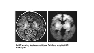 A- MRI showing focal neuronal injury; B- Diffuse weighted MRI
showing HIE
 