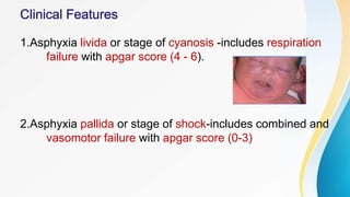 1.Asphyxia livida or stage of cyanosis -includes respiration
failure with apgar score (4 - 6).
2.Asphyxia pallida or stage of shock-includes combined and
vasomotor failure with apgar score (0-3)
 