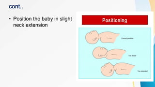 • Position the baby in slight
neck extension
 