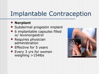 Norplant R2 Gynecology 5th year, 1st & 2nd lectures (Dr. Muhabat Salih Saeid) | PPT