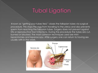 Tubal LigationKnown as “getting your tubes tied,” closes the fallopian tubes via surgical procedure. This stops the egg from traveling to the uterus and also prevents sperm from reaching the fallopian tubes. Surgery does not prevent against STIs or reproductive tract infections. During the procedure the tubes are cut, burned or blocked. The most common techniques used are mini-laparotomies and laparoscopy. After surgery one can return to having sex usually with in the week. 