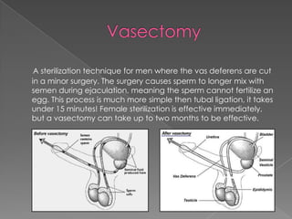 VasectomyA sterilization technique for men where the vas deferens are cut in a minor surgery. The surgery causes sperm to longer mix with semen during ejaculation, meaning the sperm cannot fertilize an egg. This process is much more simple then tubal ligation, it takes under 15 minutes! Female sterilization is effective immediately, but a vasectomy can take up to two months to be effective.