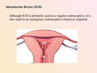 Intrauterine Device (IUD)
Although IUD is primarily used as a regular contraceptive, it is
also used as an emergency contraceptive whenever required.
 
