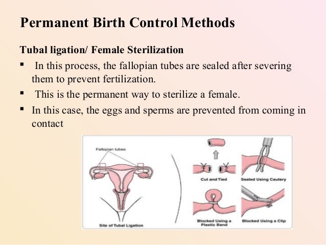 Best option for permanent birth control