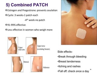 Zafemy Patch Rx Example Birth Control Patch Placement