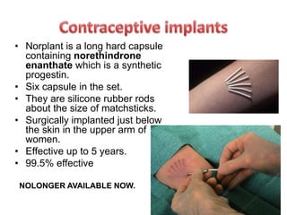 • Norplant is a long hard capsule
containing norethindrone
enanthate which is a synthetic
progestin.
• Six capsule in the set.
• They are silicone rubber rods
about the size of matchsticks.
• Surgically implanted just below
the skin in the upper arm of
women.
• Effective up to 5 years.
• 99.5% effective
NOLONGER AVAILABLE NOW.
 