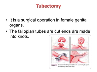 • It is a surgical operation in female genital
organs.
• The fallopian tubes are cut ends are made
into knots.
 