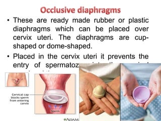 • These are ready made rubber or plastic
diaphragms which can be placed over
cervix uteri. The diaphragms are cup-
shaped or dome-shaped.
• Placed in the cervix uteri it prevents the
entry of spermatozoa into the cervical
canal and thus prevents fertilization.
 