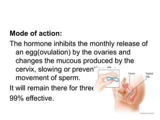 Mode of action:
The hormone inhibits the monthly release of
an egg(ovulation) by the ovaries and
changes the mucous produced by the
cervix, slowing or preventing the
movement of sperm.
It will remain there for three weeks.
99% effective.
 