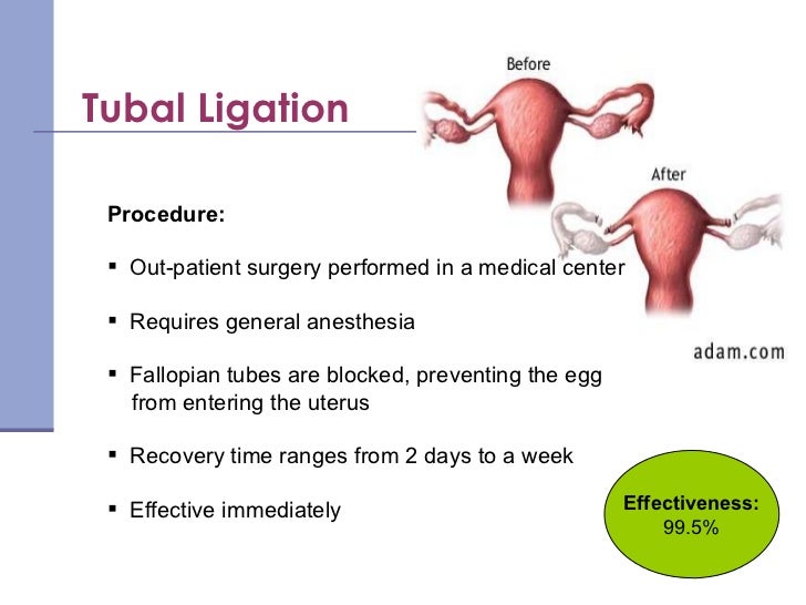 Birth Control Methods