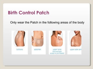 Birth Control Patch
 Only wear the Patch in the following areas of the body
 