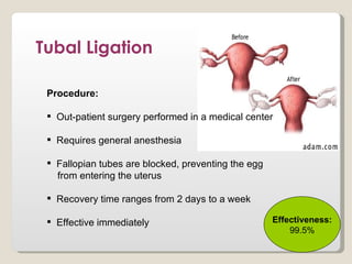 Tubal Ligation

 Procedure:

  Out-patient surgery performed in a medical center

  Requires general anesthesia

  Fallopian tubes are blocked, preventing the egg
   from entering the uterus

  Recovery time ranges from 2 days to a week

  Effective immediately                             Effectiveness:
                                                         99.5%
 