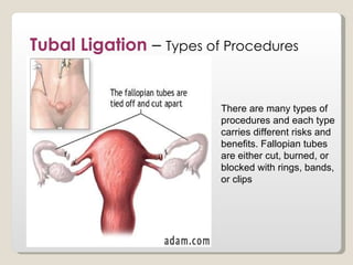 Tubal Ligation – Types of Procedures


                         There are many types of
                         procedures and each type
                         carries different risks and
                         benefits. Fallopian tubes
                         are either cut, burned, or
                         blocked with rings, bands,
                         or clips
 