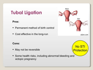 Tubal Ligation
Pros:

 Permanent method of birth control

 Cost effective in the long-run


Cons:
                                                    No STI
 May not be reversible                            Protection
 Some health risks, including abnormal bleeding and
  ectopic pregnancy
 