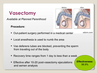 Vasectomy
Available at Planned Parenthood

   Procedure:

    Out-patient surgery performed in a medical center

    Local anesthesia is used to numb the area

    Vas deferens tubes are blocked, preventing the sperm
     from traveling out of the body

    Recovery time ranges from 1 day to less than a week

    Effective after 10-20 post-vasectomy ejaculations   Effectiveness:
     and semen analysis                                      99.9%
 