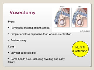 Vasectomy
Pros:

 Permanent method of birth control

 Simpler and less expensive than woman sterilization

 Fast recovery

Cons:                                                    No STI
 May not be reversible
                                                        Protection

 Some health risks, including swelling and early
failure
 
