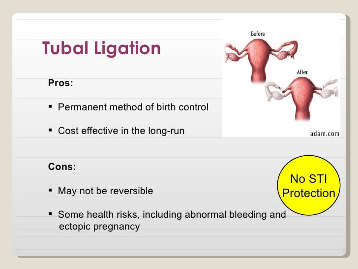 Best option for permanent birth control