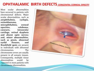 OPHTHALAMIC BIRTH DEFECTS CONGENITAL CORNEAL OPACITY
Most ocular abnormalities
have occurred in patients with
chromosomal defects. Major
ocular abnormalities, such as
anophthalmia, cyclopia,
retinoblastoma,
microphthalmia, corneal
opacities, coloboma,
cataracts, intraocular
cartilage, retinal dysplasia
and absent optic nerves;
and, minor abnormalities,
such as ptosis, abnormal
eyelid fissures, and
Brushfield spots are present
in individuals with abnormal
chromosomes. The
chromosome errors are usually
present in all somatic tissues.
Consequently, multiple tissue
abnormalities would be
expected in most patients with
chromosome abnormalities.
 