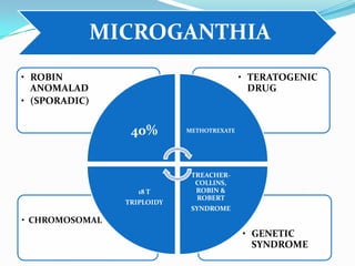 MICROGANTHIA
• GENETIC
SYNDROME
• CHROMOSOMAL
• TERATOGENIC
DRUG
• ROBIN
ANOMALAD
• (SPORADIC)
40% METHOTREXATE
TREACHER-
COLLINS,
ROBIN &
ROBERT
SYNDROME
18 T
TRIPLOIDY
 