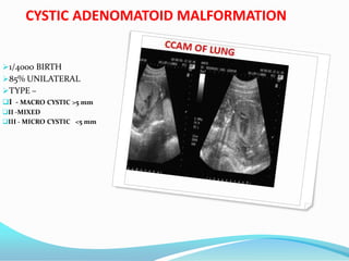 CYSTIC ADENOMATOID MALFORMATION
1/4000 BIRTH
85% UNILATERAL
TYPE –
I - MACRO CYSTIC >5 mm
II -MIXED
III - MICRO CYSTIC <5 mm
 